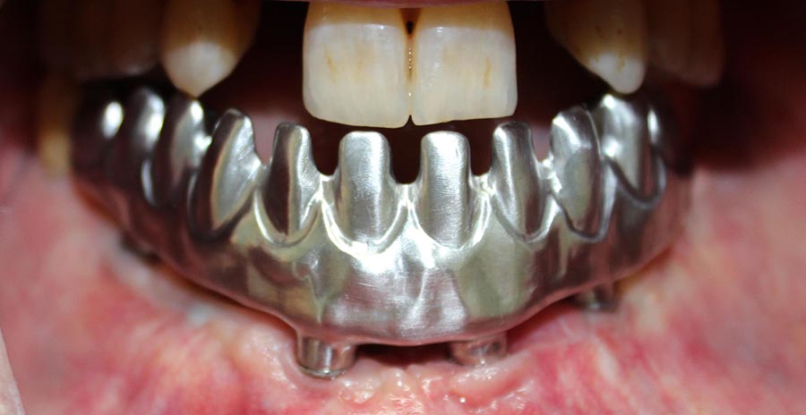 Case Study Lower Jaw Implant Bridge Northland Prosthodontics