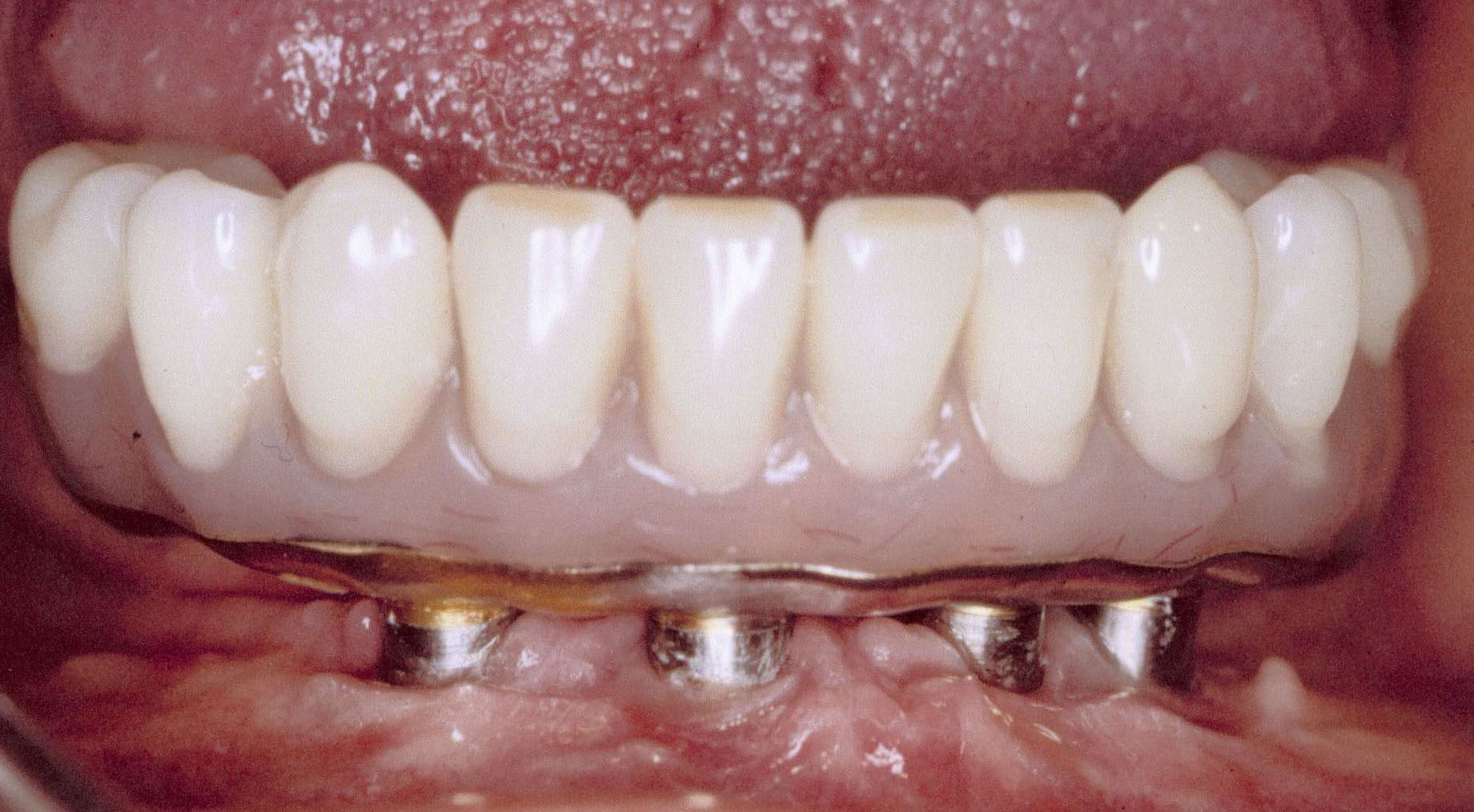 2-lower-implant-bridge-on-4-implants