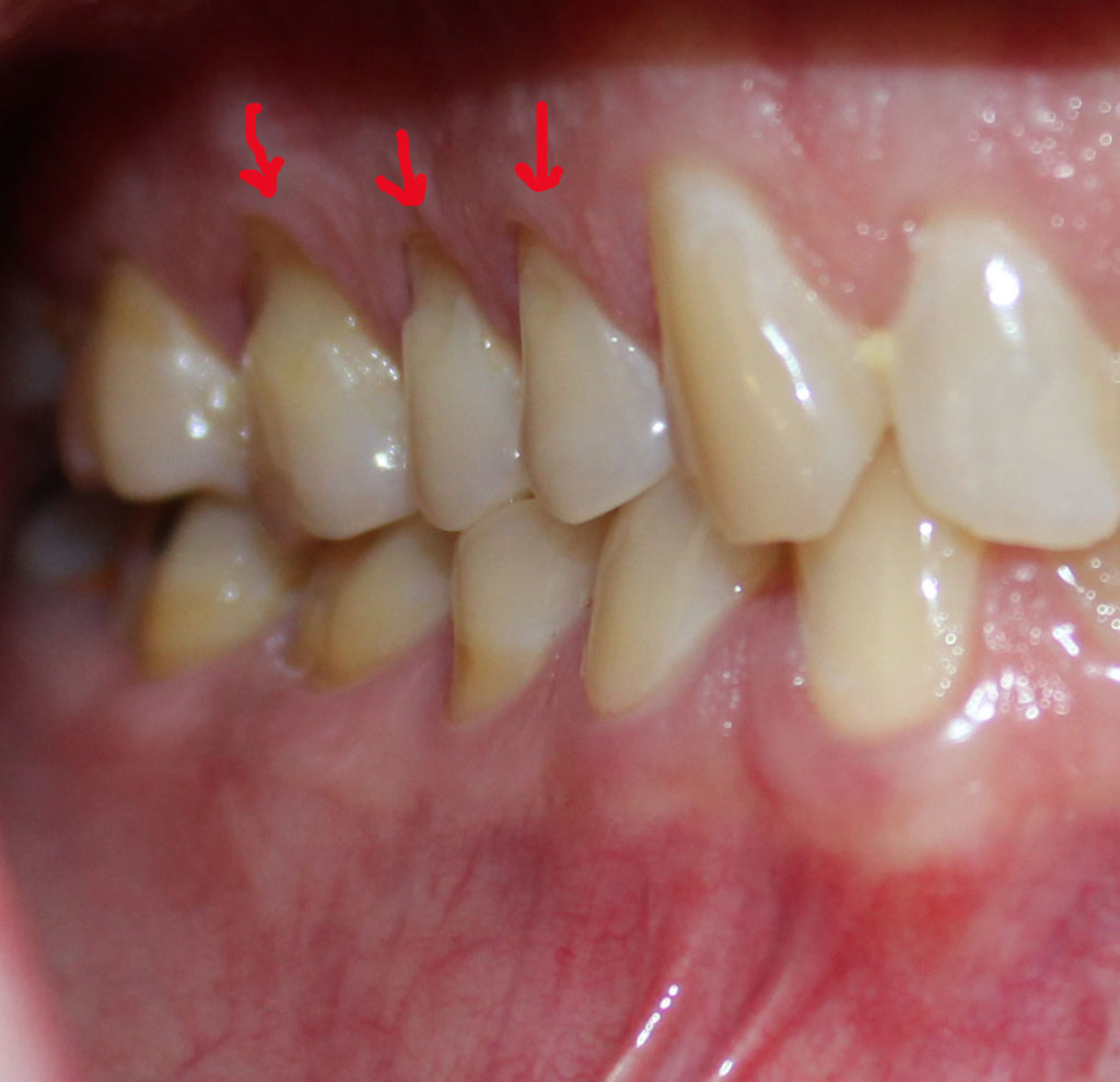 Tooth Grinding and TMJ Joint Disorders Northland Prosthodontics