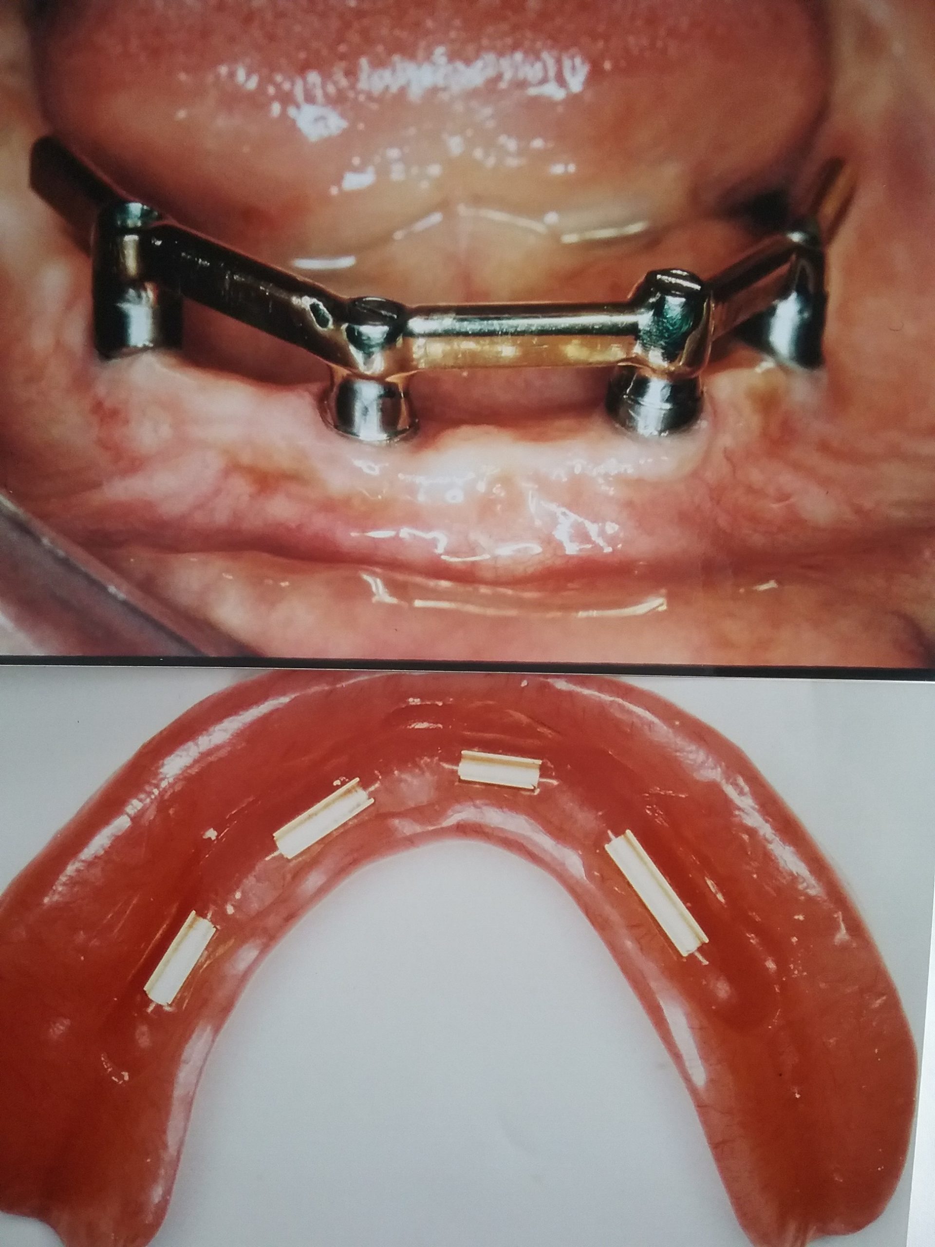 LOWER IMPLANT DENTUREBAR DESIGN 2