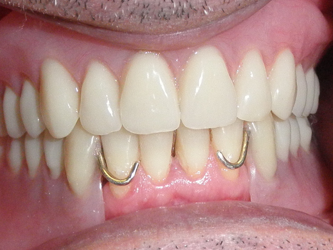 partial denture dentures upper lower metal teeth complete dental plates spot