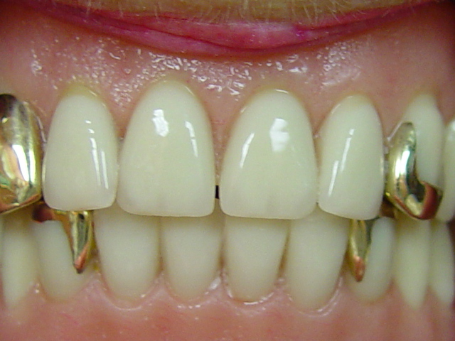 dentures with gold on them