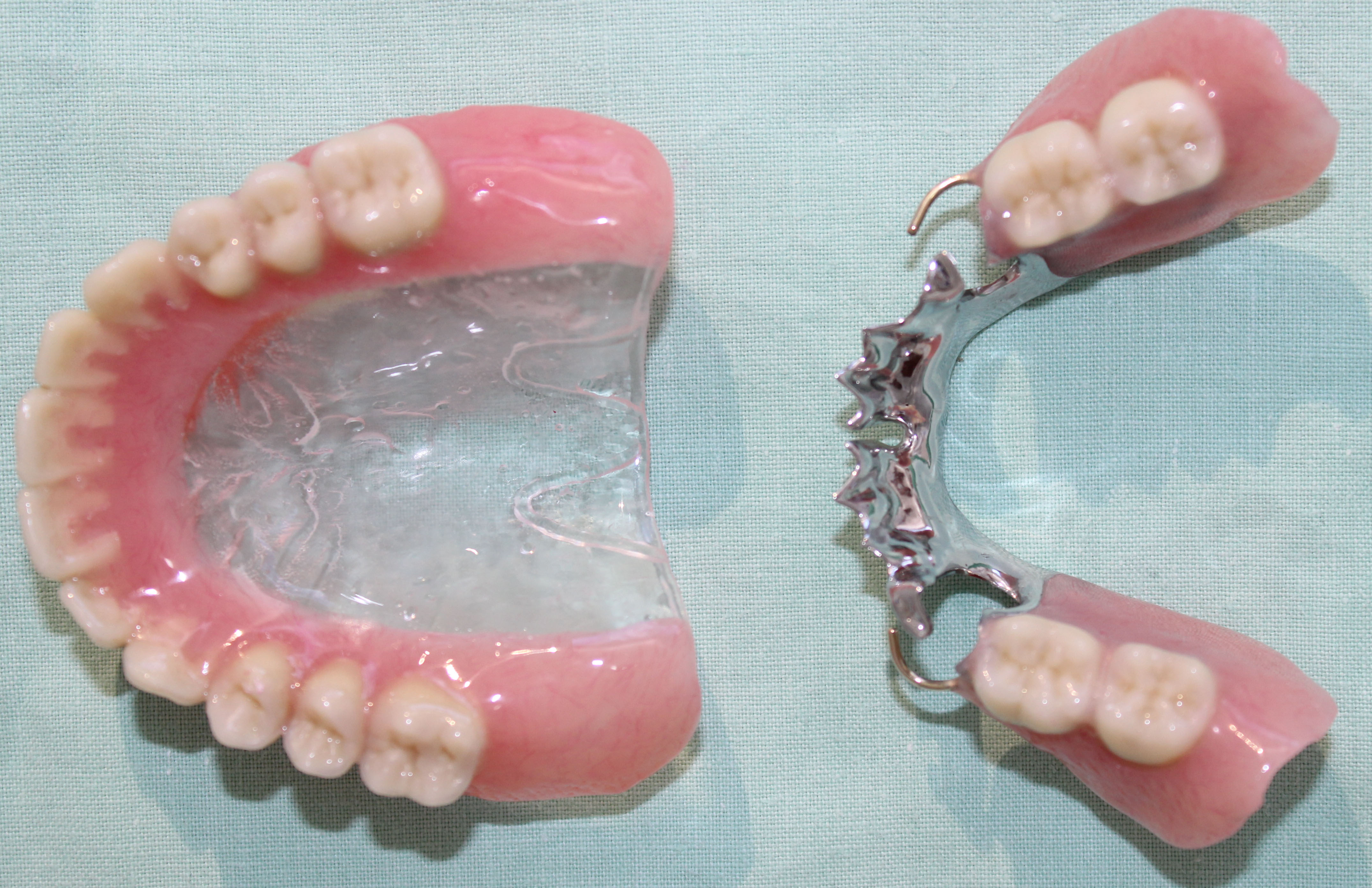 2 Lower Metal Partial Denture And A Complete Upper Denture   2 LOWER METAL PARTIAL DENTURE AND A COMPLETE UPPER DENTURE 