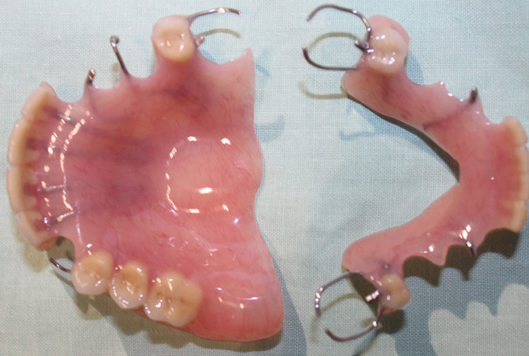 Partial Dentures (plates) Northland Prosthodontics Northland