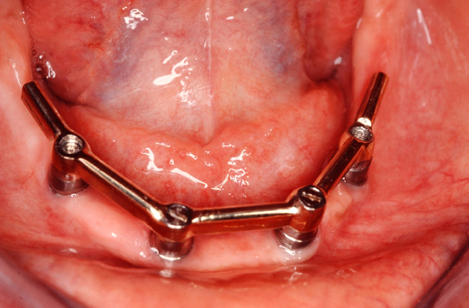 4lowerjawbarimplantoverdenture