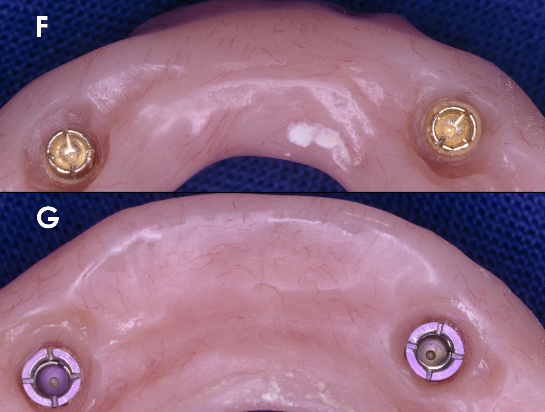 LOWER IMPLANT DENTURE ATTACHMENTS 1