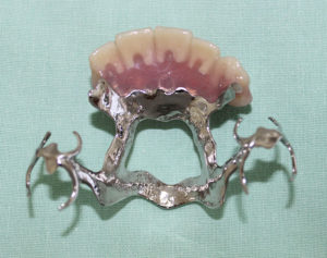 metal-partial-denture-replacing-front-teeth