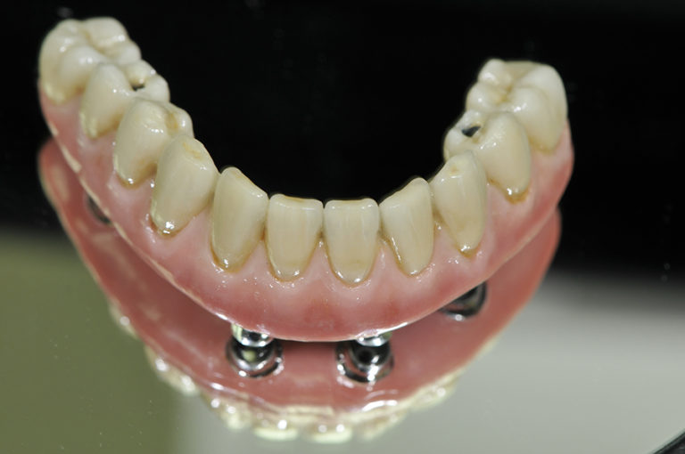 11_Permanent metal ceramic bridge1