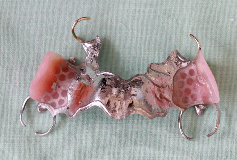 Partial Dentures (plates) Northland Prosthodontics Northland