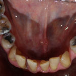 CASE STUDY –Lower Jaw Implant Bridge - Northland Prosthodontics ...