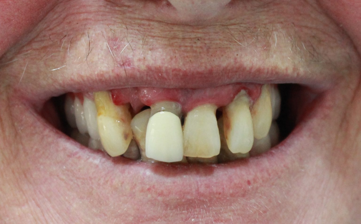 Complete Dentures Northland Prosthodontics Northland Denture