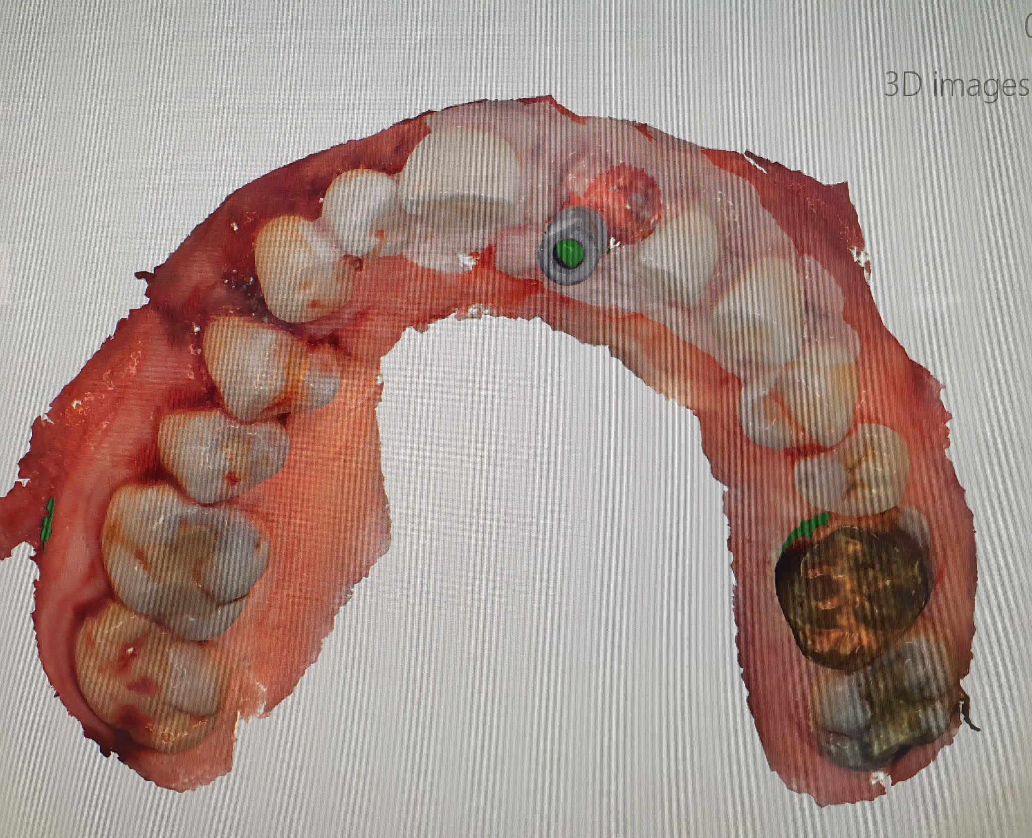 6Digital scan for temporary implant crown