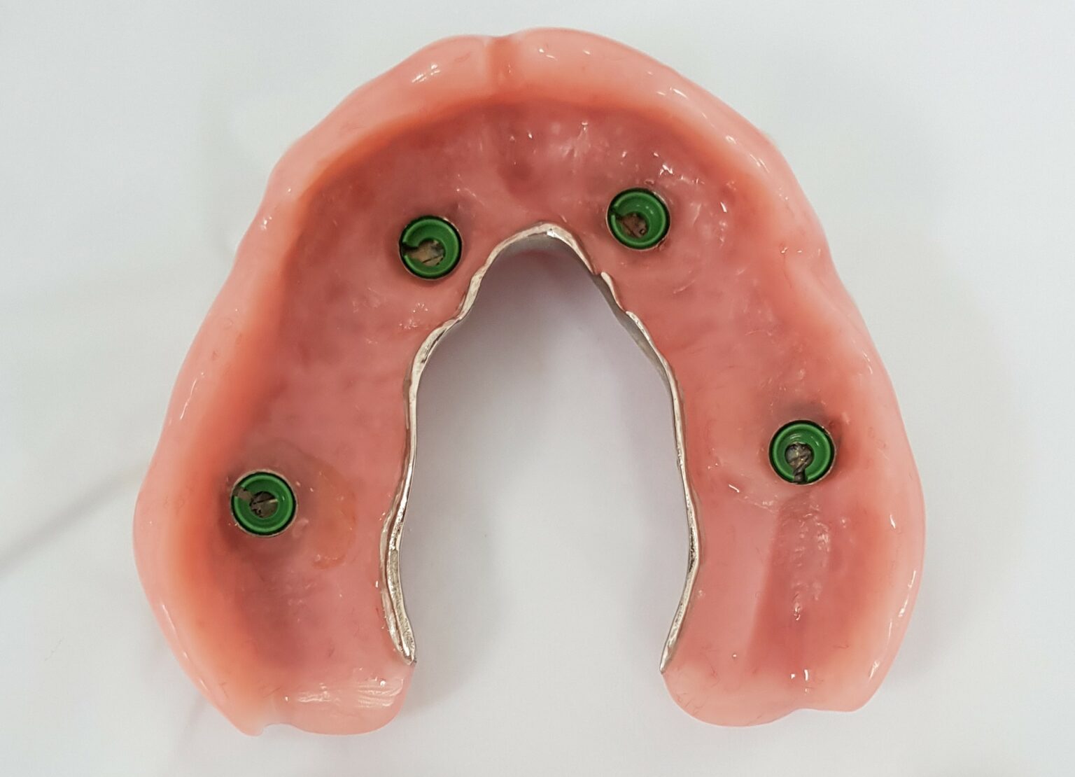 Implant Dentures