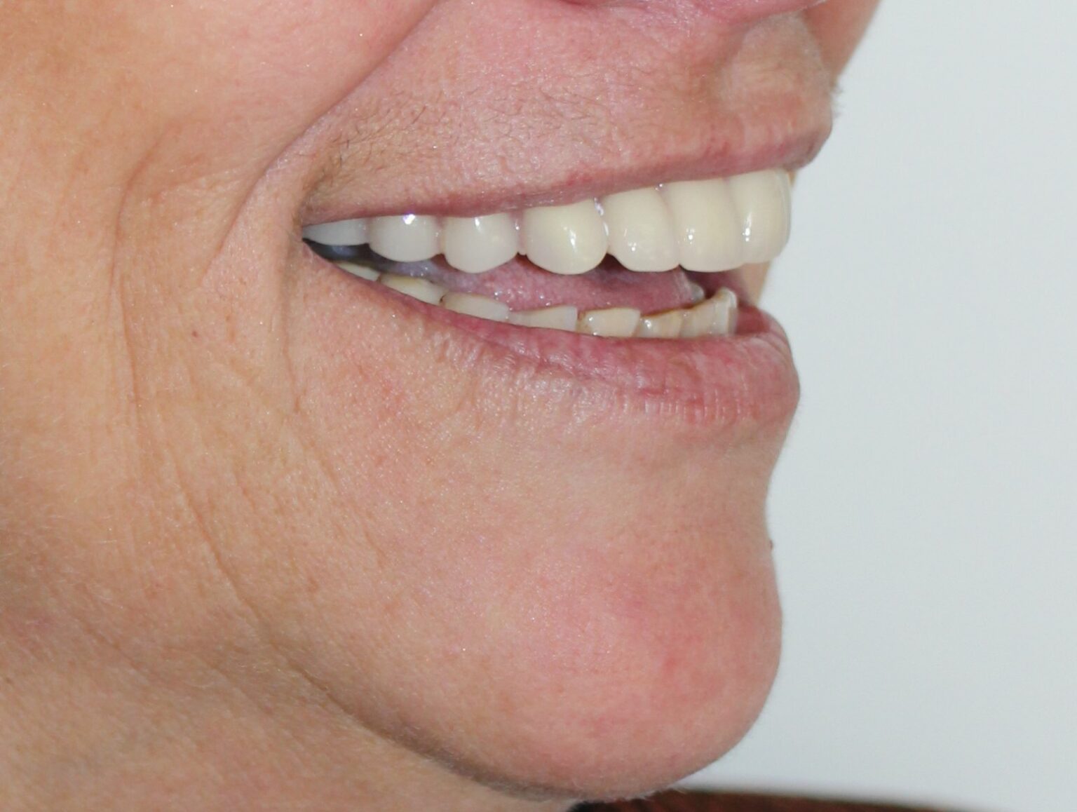 Partial Dentures (plates)