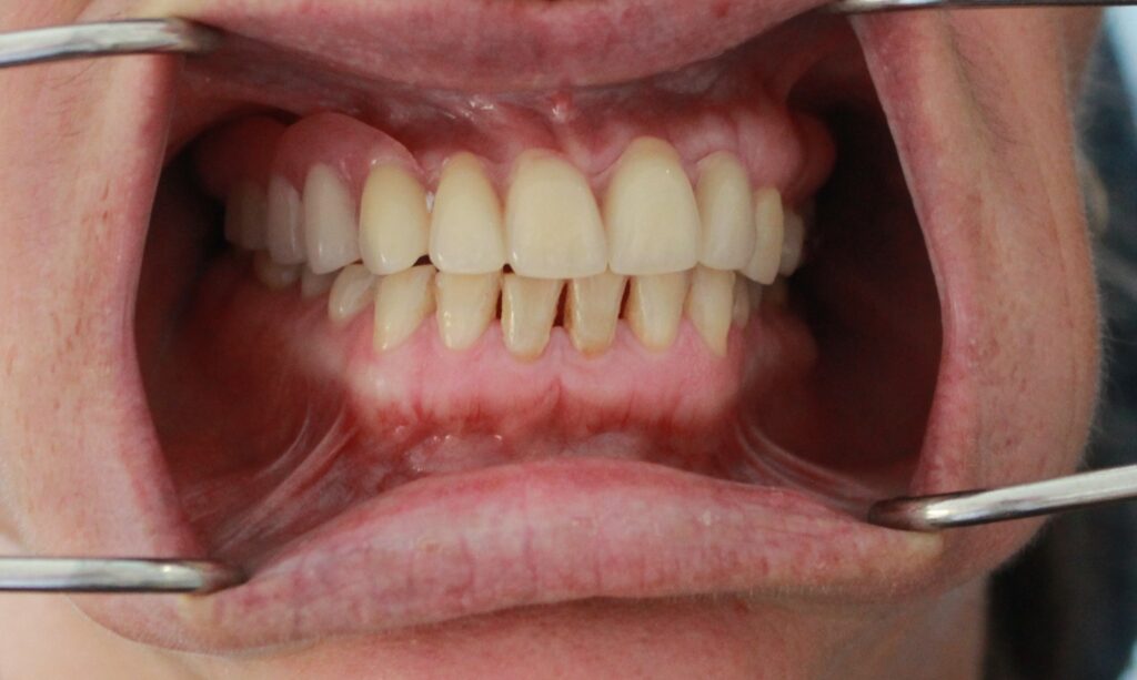 Partial Dentures (plates)