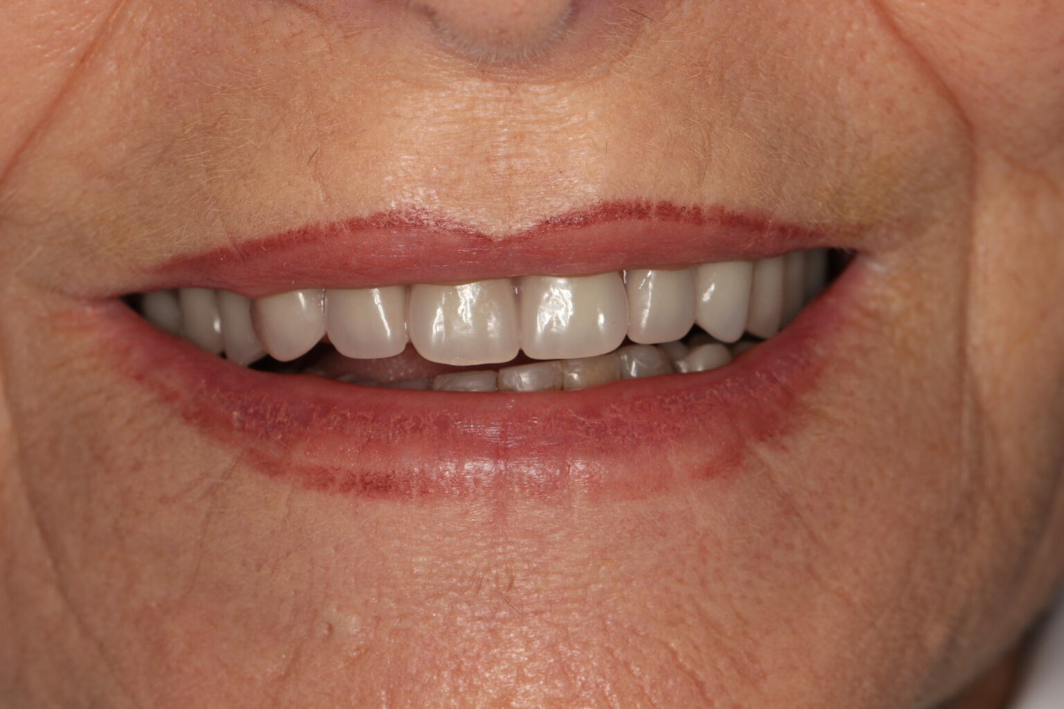 Implant Dentures (Partial)