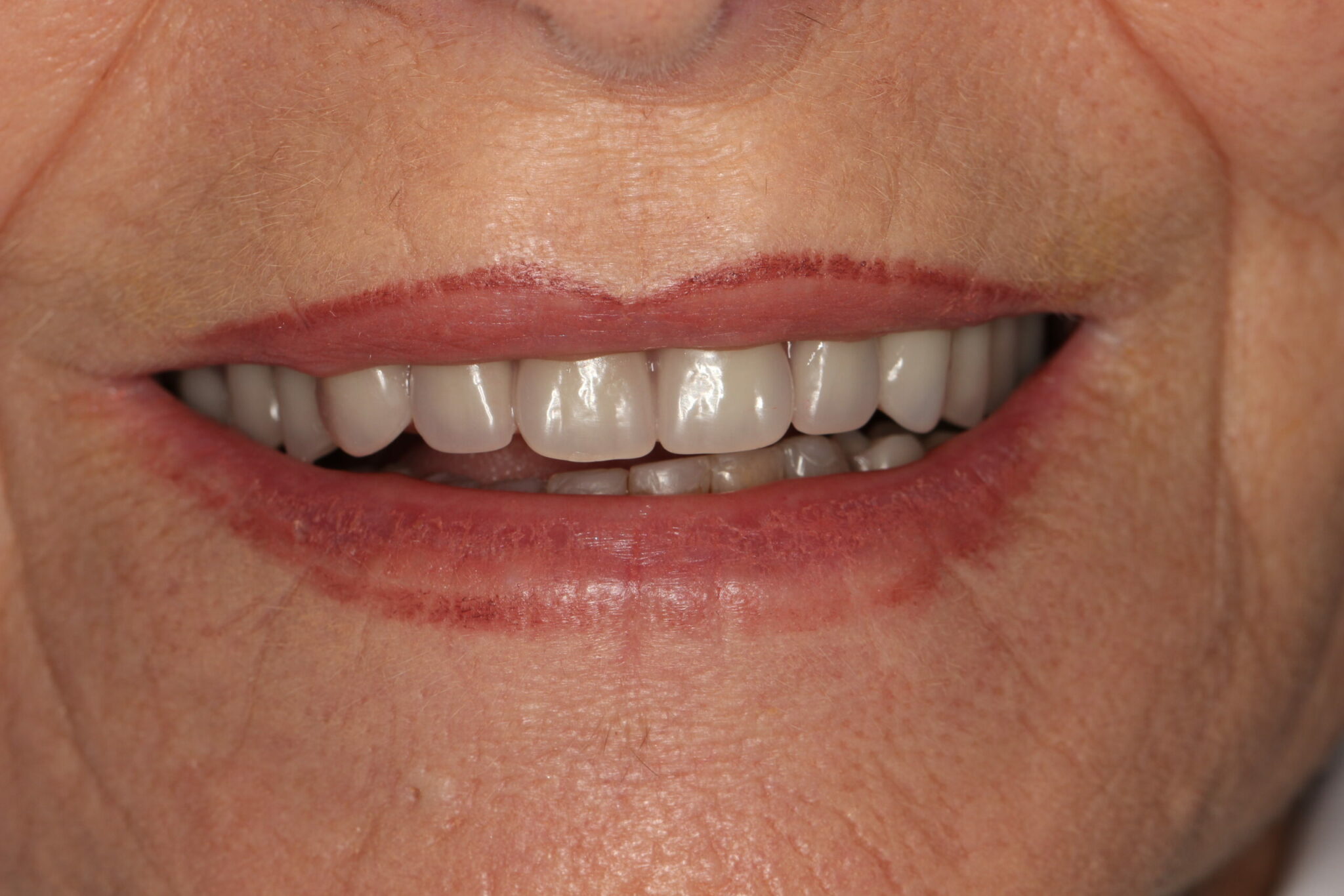 Implant Dentures Partial 