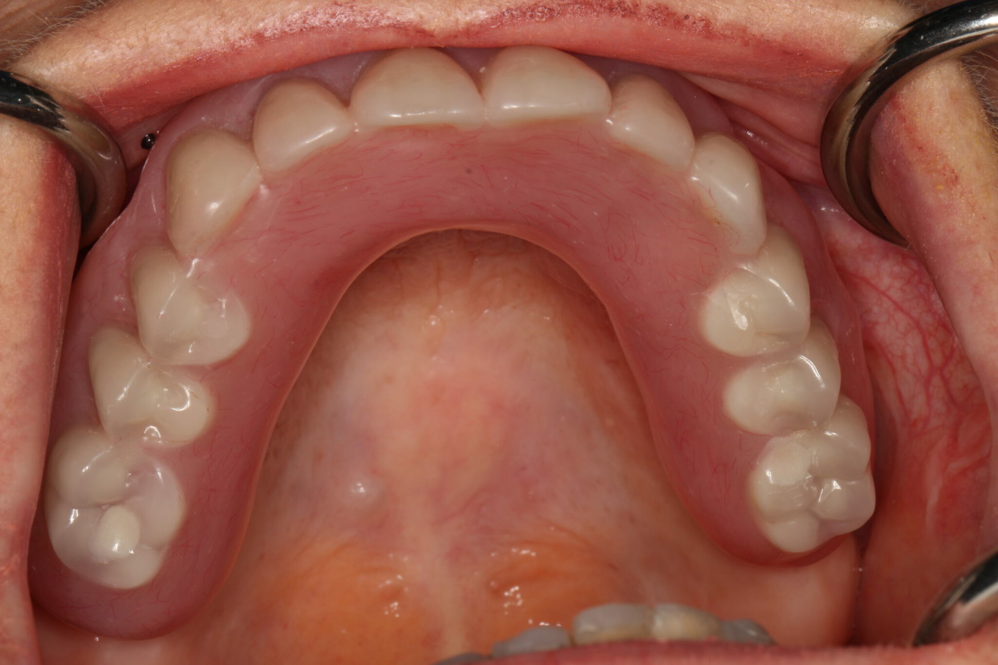 Implant Dentures (Partial)