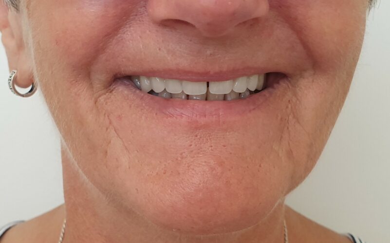 Partial Dentures (plates)